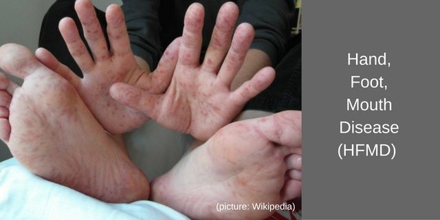 Hand-, Fuß- und Mundkrankheit